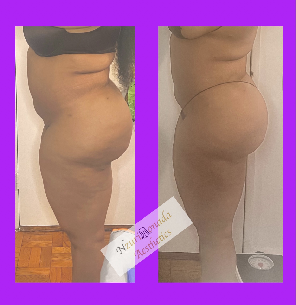 Before and after stomach lipo and cellulite reduction