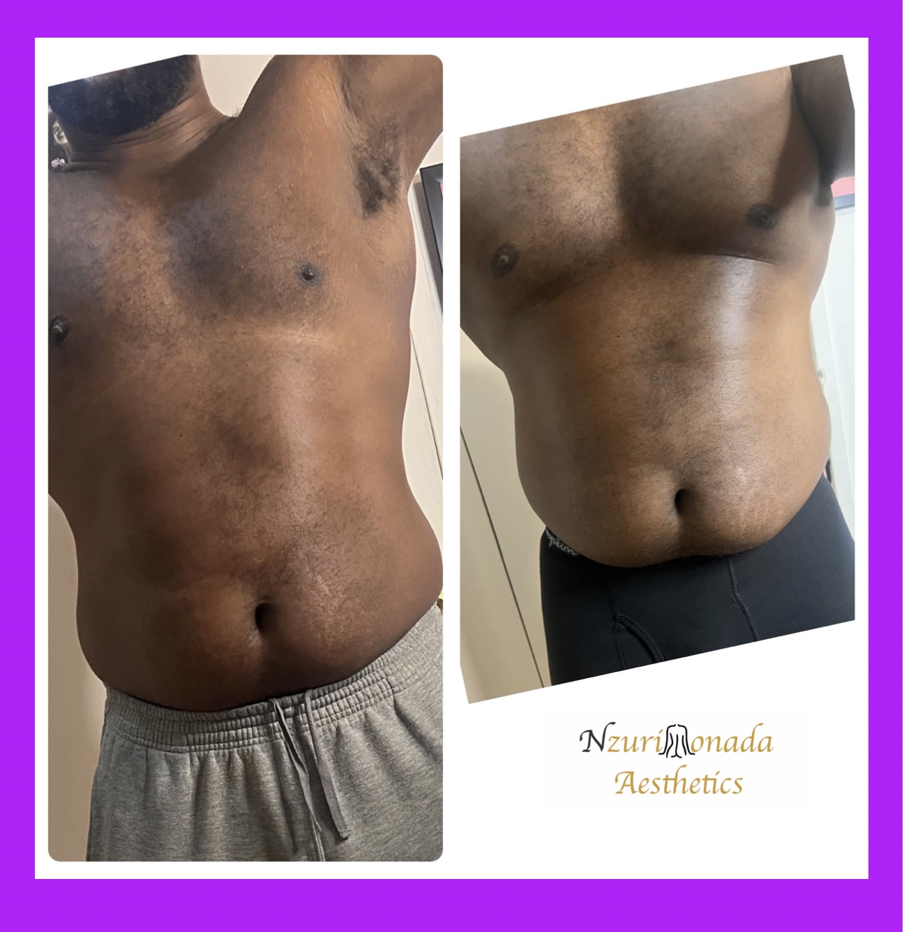 Before and after Male Body Sculpting - Bronx , NY