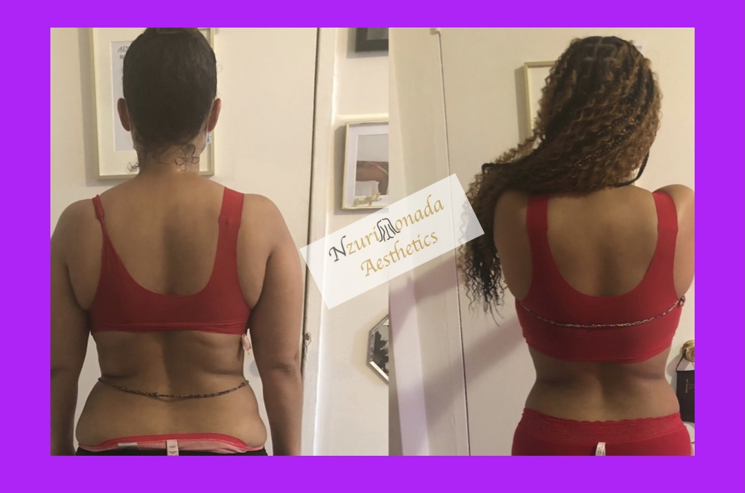 Before and After Back Lipo Post Op