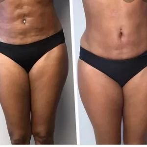 Before and After Lipo suction surgery