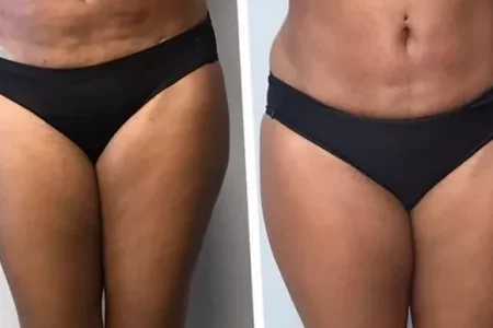 Before and After Lipo suction surgery