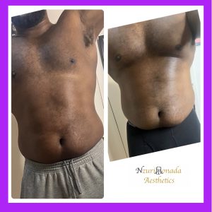 Before and After Stomach Body Contouring